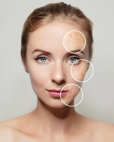 Webinar: Nega nečiste kože z naravno kozmetiko